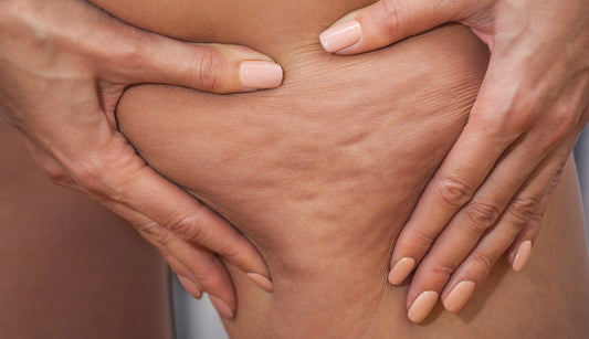 Understanding Cellulite and Effective Treatment Options